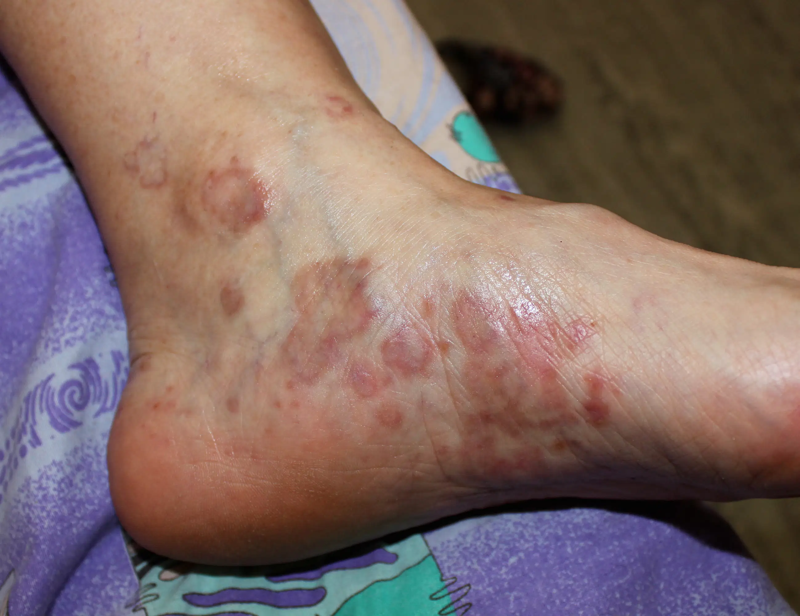 What is Lichen Planus?